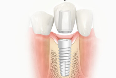 Dental Implant In Kalyani Nagar Pune | Dr. Thareja's Dental Clinic