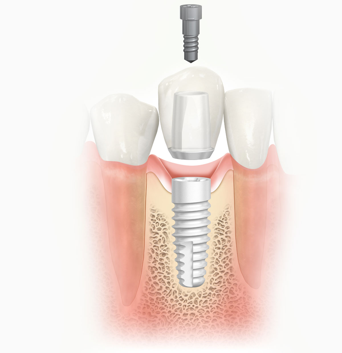 Dental Implant In Kalyani Nagar Pune | Dr. Thareja's Dental Clinic