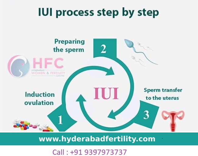 IUI Treatment in Hyderabad