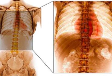 Top Spine Tumor Specialist in Lucknow – Axis Spine Centre