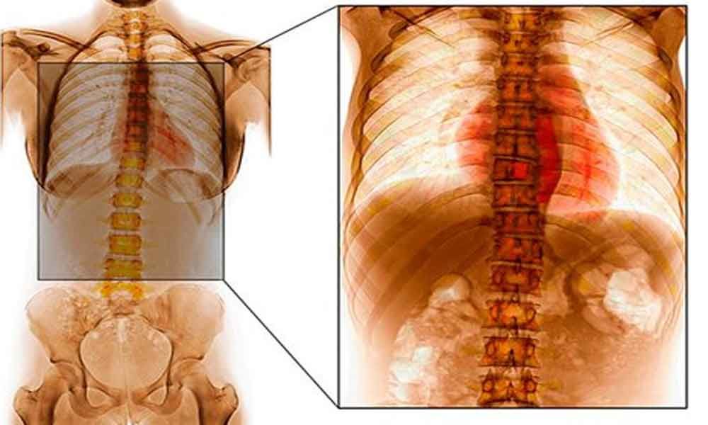 Top Spine Tumor Specialist in Lucknow – Axis Spine Centre