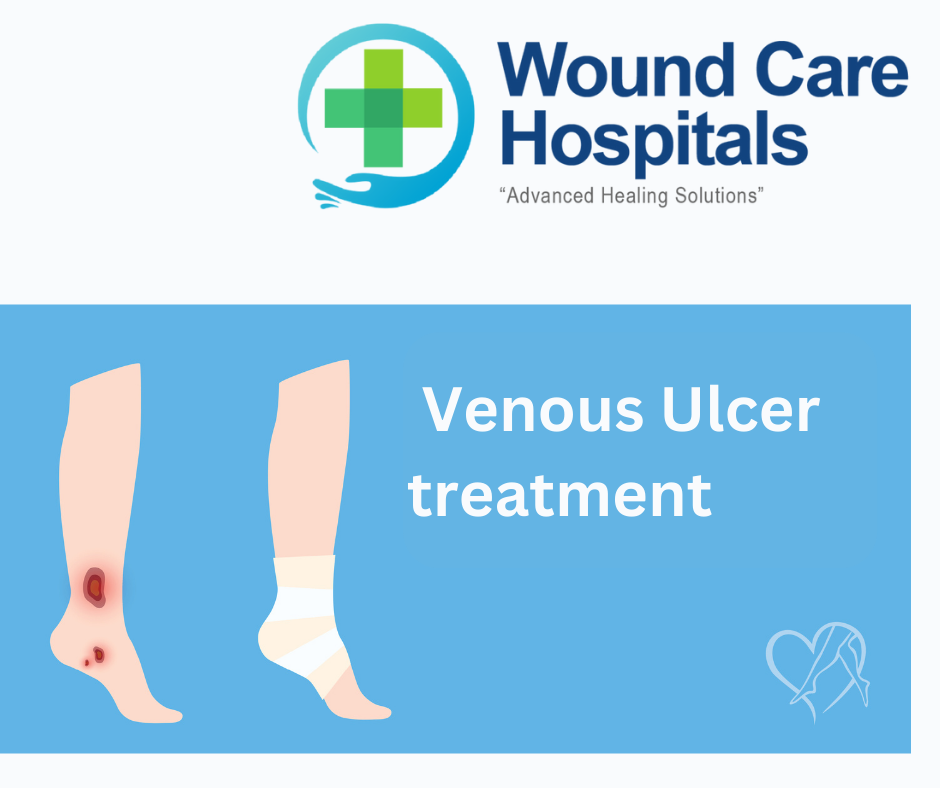 Best Venous Ulcer treatment in Hyderabad | Kukatpally | KPHB – WCH