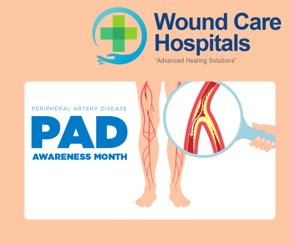 Peripheral Arterial Disease Treatment in Hyderabad | kukatpally – WCH