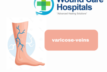 Varicose Veins Treatment in Hyderabad | Kukatpally | KPHB – WCH