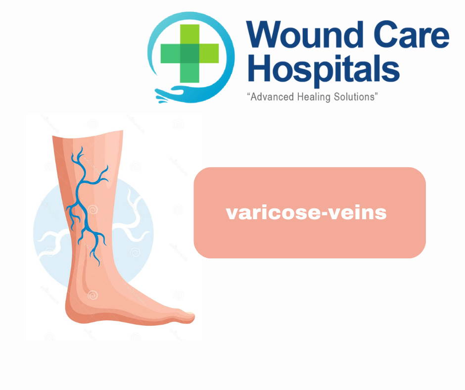 Varicose Veins Treatment in Hyderabad | Kukatpally | KPHB – WCH