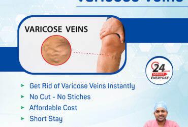 Varicose Veins Treatment in Hyderabad | kukatpally – Treatment Range Hospital