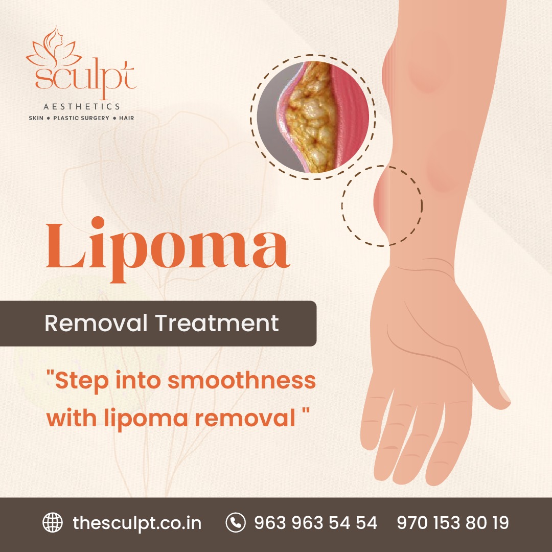 lipoma treatment in hyderabad